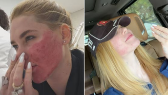 A influenciadora compartilhou com seus mais de 53 milhões de seguidores detalhes do processo de cicatrização do procedimento estético que fez