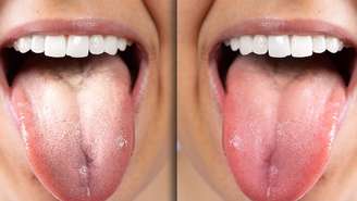 Higiene bucal adequada e boa hidratação ajudam a prevenir a formação da placa branca na língua – depositphotos.com / sruilk