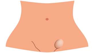 A hérnia inguinal surge na região da virilha quando parte do intestino protrude por um ponto enfraquecido da musculatura abdominal – depositphotos.com / mikrostoker