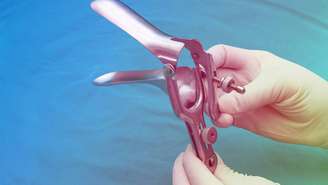 O exame de papanicolau é um dos principais métodos utilizados na saúde feminina para detectar alterações nas células do colo do útero antes que se transformem em doença mais grave – depositphotos.com / plepraisaeng