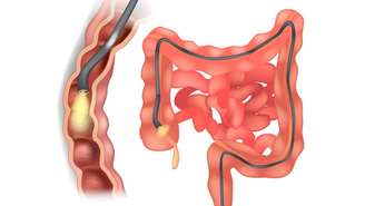 Além do diagnóstico, o exame possibilita tratamentos durante o procedimento, como biópsias e controle de sangramentos – depositphotos.com / Sakurra