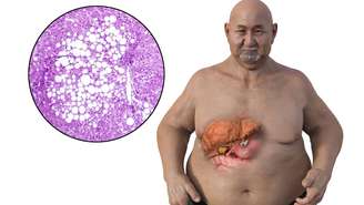 Em casos mais avançados, surgem icterícia, urina escura e coceira pelo corpo, indicando inflamação no fígado e necessidade de acompanhamento médico imediato -depositphotos.com / katerynakon