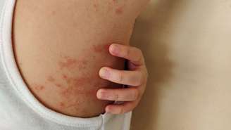 Brasil é o segundo país no mundo com mais casos de Hanseníase