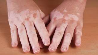 Apesar de ser uma alteração visível, o vitiligo não é contagioso e não associa-se à falta de higiene – depositphotos.com / buecax