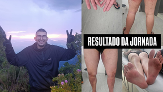 Irmã de jovem que se perdeu em trilha no Pico Paraná divulga imagens das lesões