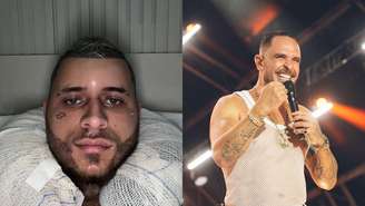 Veja quais artistas já fizeram transplante capilar.