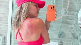 Veja como cuidar da pele para evitar queimaduras nesse verão. Foto: Reprodução/ Instagram @renazarazua