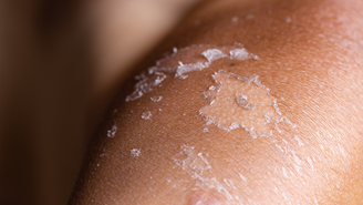 De acordo com dermatologistas, a pele descascando é resultado da divisão celular e dos danos causados pela exposição excessiva aos raios UV