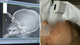 Objeto perfurante atravessou o osso do crânio da criança e atingiu o tecido cerebral