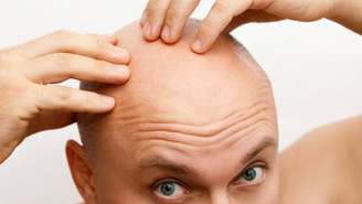 A calvície masculina, que tem o nome de alopecia androgenética, associa-se principalmente a fatores hormonais e genéticos – depositphotos.com / arribalko