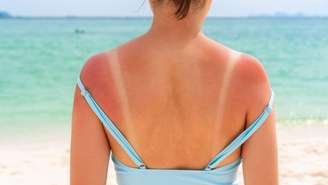 Veja como usar a babosa para queimaduras de sol.