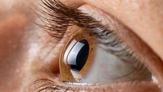 Ceratocone afina e deforma a córnea, causando visão distorcida e sensibilidade à luz; entenda os sintomas e tratamentos