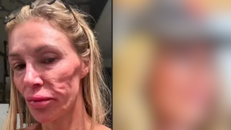 UAU! Influenciadora que teve rosto 'derretido' mostra como está após várias cirurgias / Reprodução: Instagram