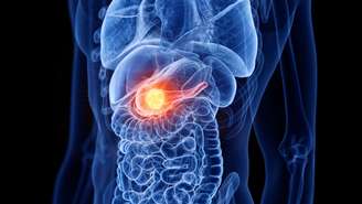 Grupo de pesquisadores conseguem eliminar câncer de pâncreas com combinação tripla de remédios