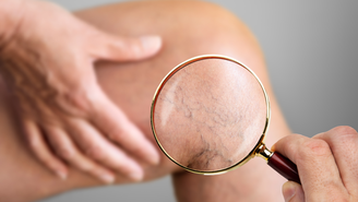 As atividades físicas, quando praticadas corretamente, estimulam a circulação sanguínea, reduzindo as dores e o inchaço causados pelas varizes