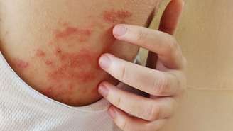 Veja como traumas psicológicos refletem na saúde da pele