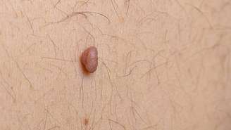 Os sinais mais comuns no corpo são conhecidos como nevos melanocíticos, popularmente chamados de pintas ou sinais – depositphotos.com / GarnaZarina