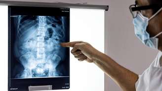 Médico mostra uma radiografia de uma "mula" do tráfico de drogas carregando cápsulas de cocaína em Caiena, Guiana Francesa. Em 16 de janeiro de 2023.