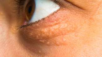 Do ponto de vista médico, o xantelasma é considerado um tipo de xantoma, que é o nome dado a acúmulos de lipídios em determinados pontos do corpo – depositphotos.com / gabitodorean