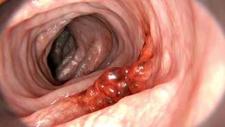 O câncer de cólon caracteriza-se pela multiplicação descontrolada de células anormais na mucosa do intestino grosso – depositphotos.com / animaxx3d