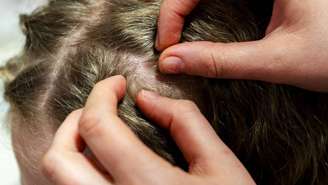 Quando o assunto envolve cabelo e couro cabeludo, especialistas lembram que é necessário diferenciar tradições populares de evidências científicas – depositphotos.com / BALKON
