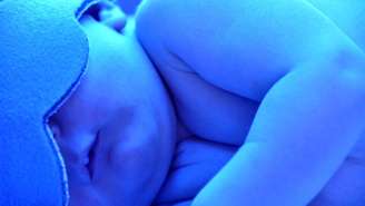 Em recém-nascidos, a chamada icterícia neonatal é frequente nos primeiros dias de vida – depositphotos.com / sserdarbasak