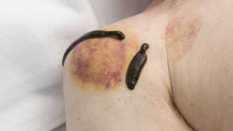 O mecanismo de ação da sanguessuga é relativamente simples: o animal se fixa à pele, faz uma pequena incisão e suga uma quantidade limitada de sangue – depositphotos.com / sdigitall