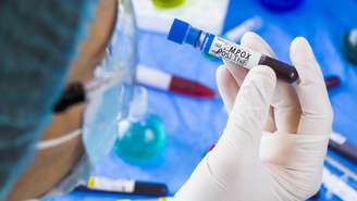 Mpox_depositphotos.com / flashback313@gmail.com