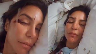 Internada, Ivete Sangalo mostra rosto machucado após queda