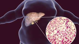 O jejum intermitente é objeto de análises com atenção pela comunidade científica como uma possível estratégia para reduzir gordura no fígado e melhorar a saúde hepática – depositphotos.com / katerynakon