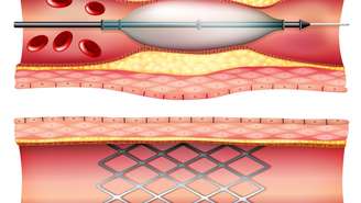 Diferente de uma cirurgia aberta, o cateterismo é feito com um tubo fino guiado até o coração, usando contraste e raio X. Em muitos casos, já na mesma sessão é possível realizar angioplastia e implantar stent, restabelecendo o fluxo sanguíneo – depositphotos.com / blueringmedia