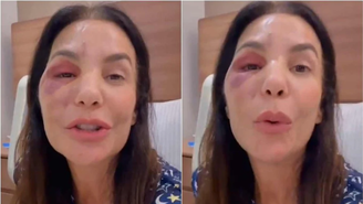 É grave? Ivete Sangalo precisa passar por cirurgia no rosto