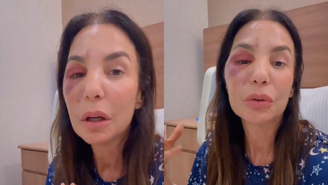 Ivete Sangalo com o rosto inchado após cirurgia. Ela precisou de atendimento médico após desmaiar