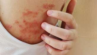 Veja como cuidar da pele atópica