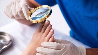 O interesse por soluções para onicomicose cresce à medida que mais pessoas buscam entender as causas, os sintomas e as opções de tratamento – depositphotos.com / Elnur_