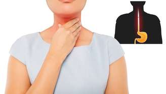 Esse retorno do ácido gástrico acontece porque a barreira natural entre o esôfago e o estômago não funciona adequadamente – depositphotos.com / Tharakorn