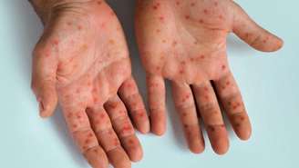 Veja como a mpox pode se espalhar dentro de casa