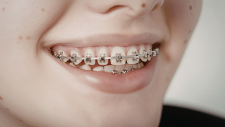 Movimentação dos dentes continua ao longo da vida e a fase de contenção, indicada após o fim do tratamento, é essencial