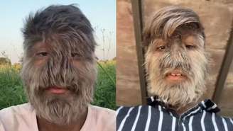 Indiano Lalit Patidar, de 19 anos, tem o rosto mais peludo do mundo