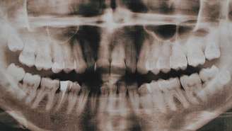 A hiperdontia é uma alteração do desenvolvimento dentário em que surgem dentes extras, os dentes supranumerários – depositphotos.com / YuliyaM