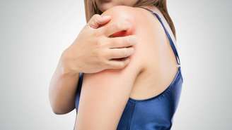 Manifesta-se com manchas claras, escuras ou amarronzadas, especialmente no tronco e ombros – depositphotos.com / Tharakorn