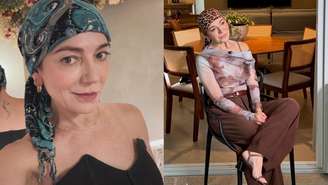 Entenda o diagnóstico de alopecia de Karina Lucco