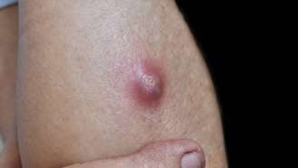 Prevenção envolve higiene adequada, roupas arejadas, cuidado com cortes e hábitos que fortalecem a imunidade – depositphotos.com / zaynyinyi