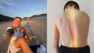 Saiba tudo sobre hérnia de disco