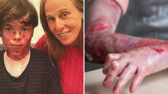 O que é epidermólise bolhosa, condição que vitimou neto de coreógrafa aos 14 anos