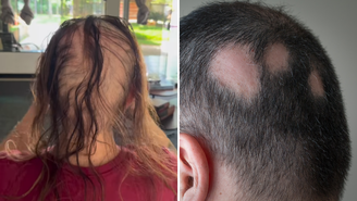 Alopecia: entenda a condição que afeta homens e mulheres