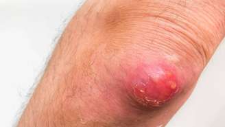 O furúnculo é, basicamente, uma infecção de um folículo piloso, que é o local de onde nasce o pelo, causada principalmente por bactérias, em especial o Staphylococcus aureus – depositphotos.com / andriano_cz