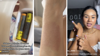Fãs afirmam que sofreram queimaduras e alergias por uso de pulseira