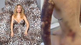 Ju Isen revela tratamento para dismorfia corporal e hematomas 