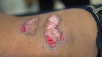 Erisipela_depositphotos.com / frankviryapan.gmail.com